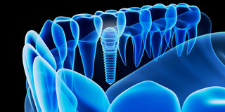Das Bild zeigt ein blau gefärbtes Modell eines Gebiss